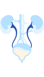 Stress urinary incontinence - male - Patient Information